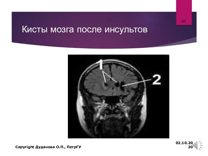 Кисты мозга после инсультов 02.10.2020 Copyright Дуданова О.П., ПетрГУ