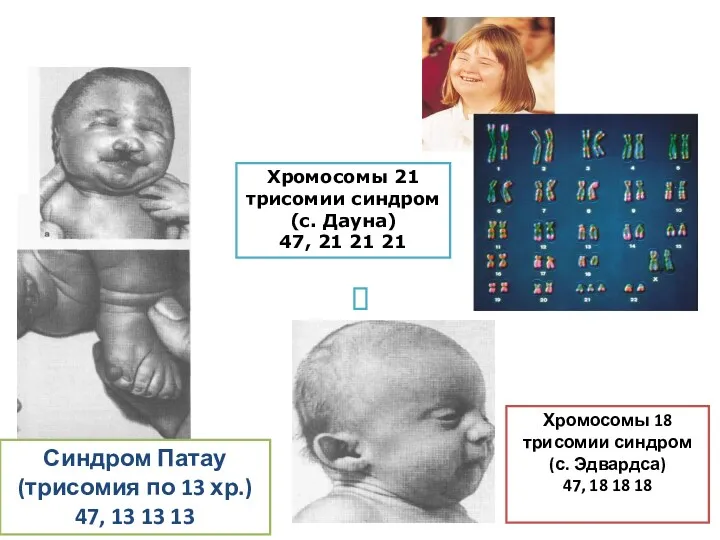 Синдром Патау (трисомия по 13 хр.) 47, 13 13 13 Хромосомы 18 трисомии