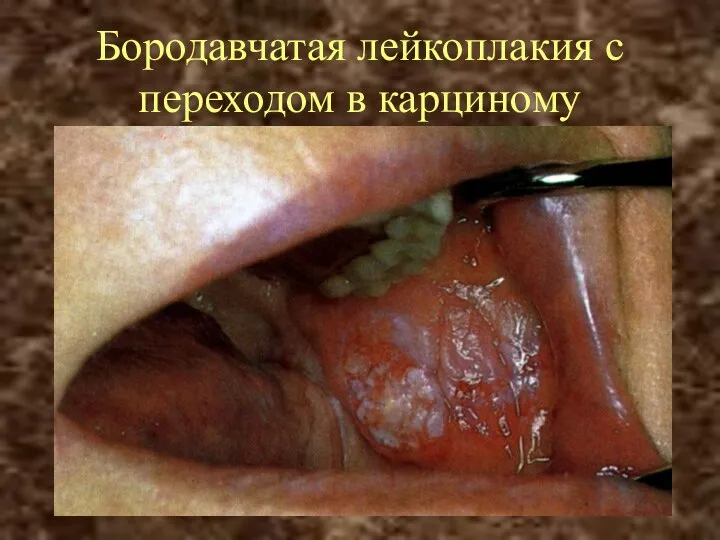 Бородавчатая лейкоплакия с переходом в карциному
