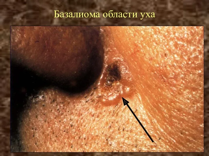 Базалиома области уха