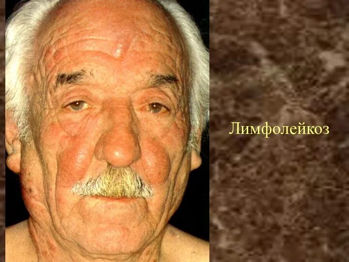 Лимфолейкоз