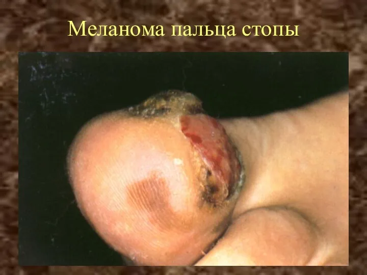 Меланома пальца стопы