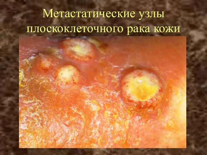 Метастатические узлы плоскоклеточного рака кожи