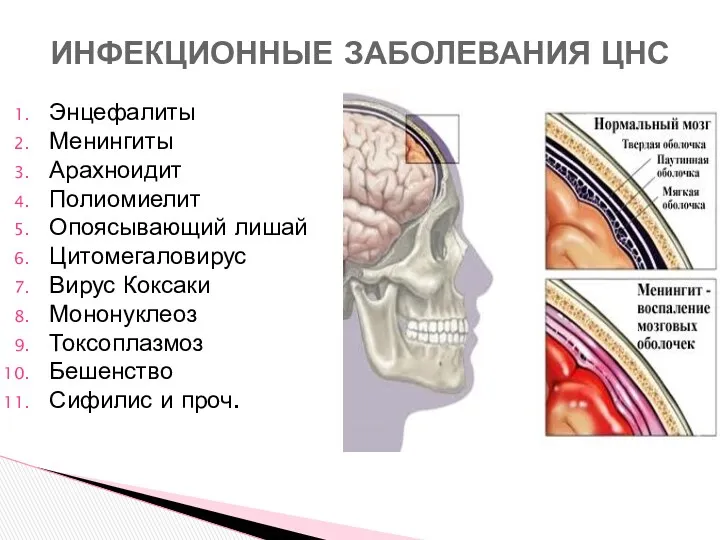 Энцефалиты Менингиты Арахноидит Полиомиелит Опоясывающий лишай Цитомегаловирус Вирус Коксаки Мононуклеоз