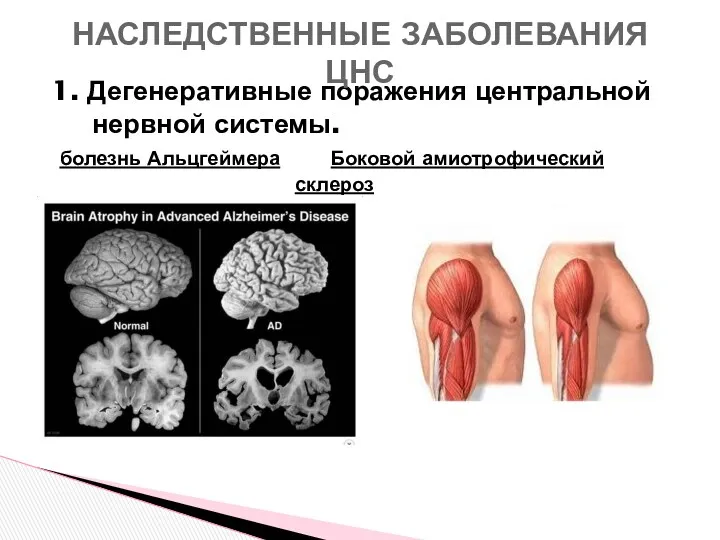 1. Дегенеративные поражения центральной нервной системы. болезнь Альцгеймера Боковой амиотрофический склероз НАСЛЕДСТВЕННЫЕ ЗАБОЛЕВАНИЯ ЦНС