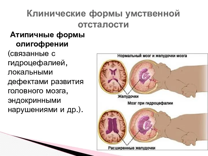 Атипичные формы олигофрении (связанные с гидроцефалией, локальными дефектами развития головного