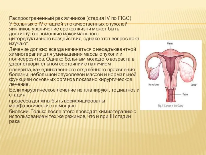 Распространённый рак яичников (стадия IV по FIGO) У больных с