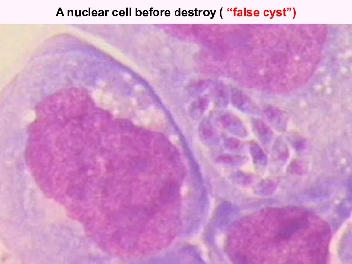 A nuclear cell before destroy ( “false cyst”)