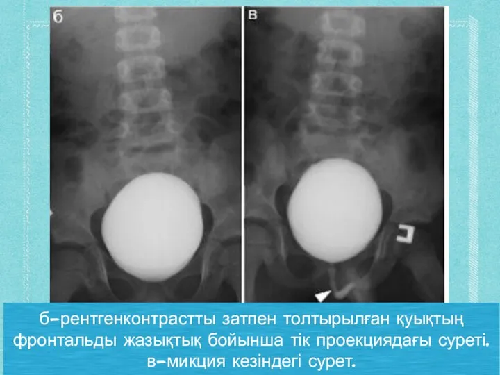 б-рентгенконтрастты затпен толтырылған қуықтың фронтальды жазықтық бойынша тік проекциядағы суреті. в-микция кезіндегі сурет.