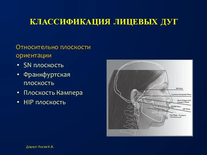 КЛАССИФИКАЦИЯ ЛИЦЕВЫХ ДУГ SN плоскость Франкфуртская плоскость Плоскость Кампера HIP