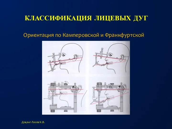 КЛАССИФИКАЦИЯ ЛИЦЕВЫХ ДУГ Доцент Лосев К.В. Ориентация по Камперовской и Франкфуртской плоскостям