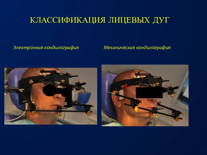 КЛАССИФИКАЦИЯ ЛИЦЕВЫХ ДУГ Электронная кондилография Механическая кондилография