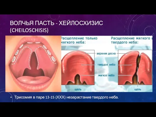 ВОЛЧЬЯ ПАСТЬ - ХЕЙЛОСХИЗИС (CHEILOSCHISIS) Трисомия в паре 13-15 (ХХХ) незарастание твердого неба.