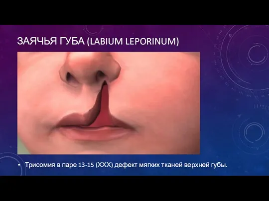 ЗАЯЧЬЯ ГУБА (LABIUM LEPORINUM) Трисомия в паре 13-15 (ХХХ) дефект мягких тканей верхней губы.