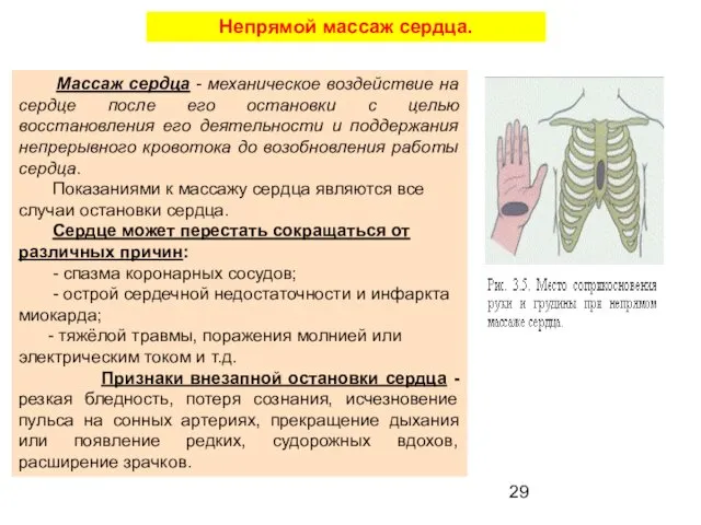 Непрямой массаж сердца. Массаж сердца - механическое воздействие на сердце