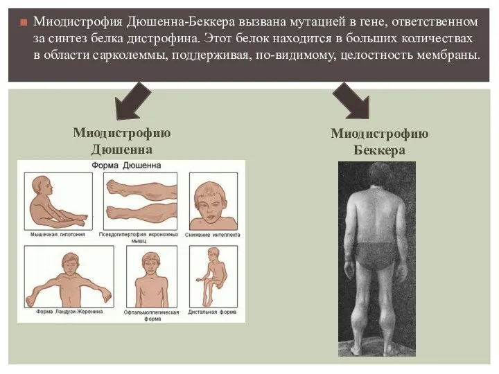 Миодистрофия Дюшенна-Беккера вызвана мутацией в гене, ответственном за синтез белка