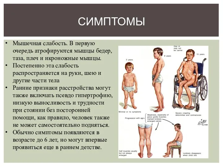 СИМПТОМЫ Мышечная слабость. В первую очередь атрофируются мышцы бедер, таза,