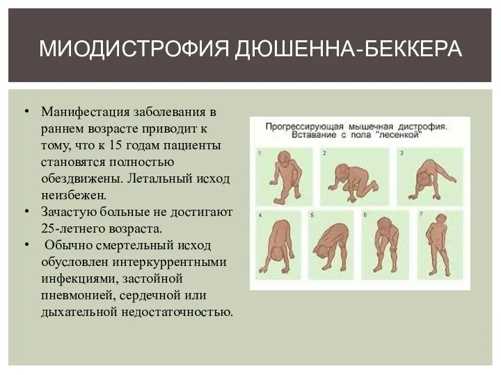 МИОДИСТРОФИЯ ДЮШЕННА-БЕККЕРА Манифестация заболевания в раннем возрасте приводит к тому,