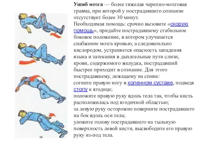 Ушиб мозга — более тяжелая черепно-мозговая травма, при которой у