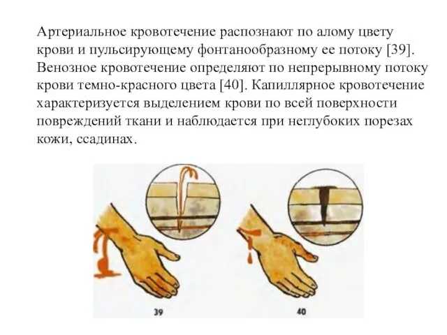 Артериальное кровотечение распознают по алому цвету крови и пульсирующему фонтанообразному