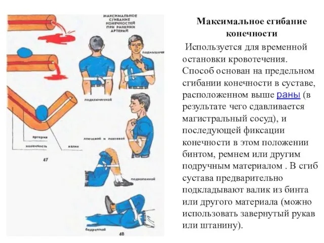 Максимальное сгибание конечности Используется для временной остановки кровотечения. Способ основан