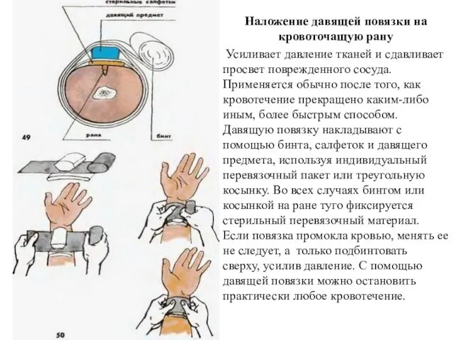 Наложение давящей повязки на кровоточащую рану Усиливает давление тканей и