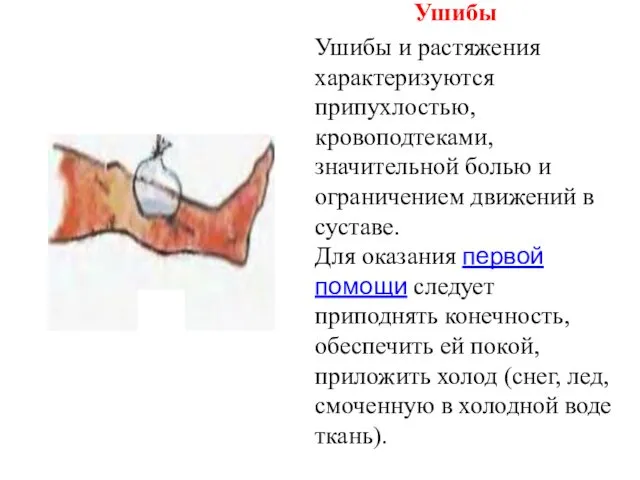 Ушибы Ушибы и растяжения характеризуются припухлостью, кровоподтеками, значительной болью и