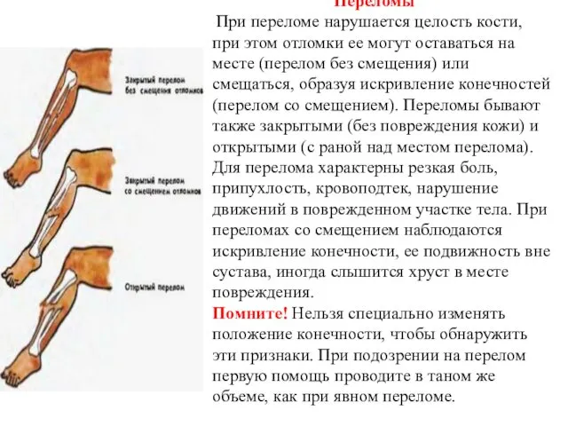 Переломы При переломе нарушается целость кости, при этом отломки ее