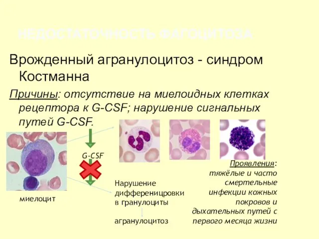 НЕДОСТАТОЧНОСТЬ ФАГОЦИТОЗА Врожденный агранулоцитоз - синдром Костманна Причины: отсутствие на