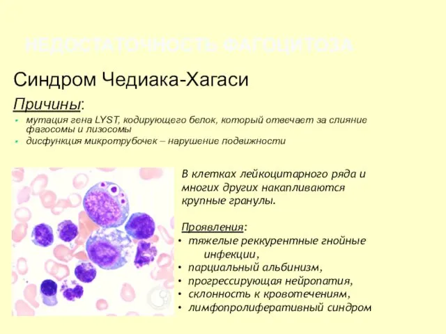 НЕДОСТАТОЧНОСТЬ ФАГОЦИТОЗА Синдром Чедиака-Хагаси Причины: мутация гена LYST, кодирующего белок,