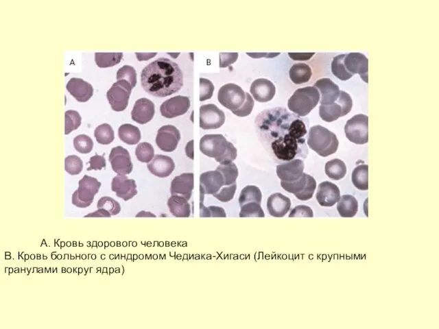 A. Кровь здорового человека B. Кровь больного с синдромом Чедиака-Хигаси (Лейкоцит с крупными гранулами вокруг ядра)