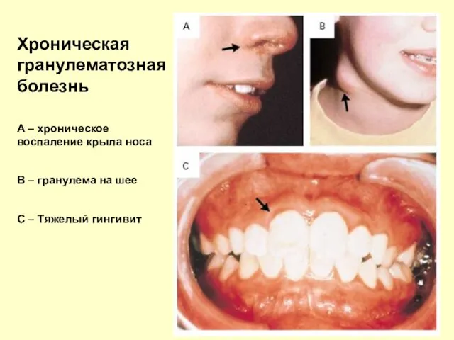 Хроническая гранулематозная болезнь А – хроническое воспаление крыла носа В
