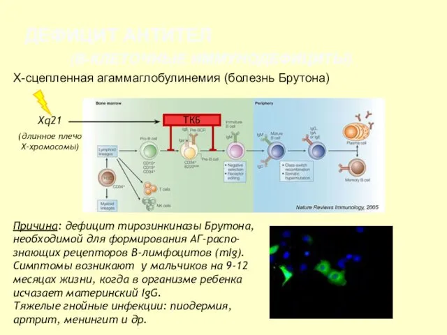 ДЕФИЦИТ АНТИТЕЛ (В-КЛЕТОЧНЫЕ ИММУНОДЕФИЦИТЫ) Х-сцепленная агаммаглобулинемия (болезнь Брутона) Причина: дефицит