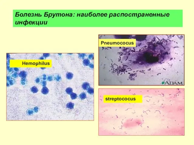 Pneumococus streptococus Hemophilus Болезнь Брутона: наиболее распостраненные инфекции