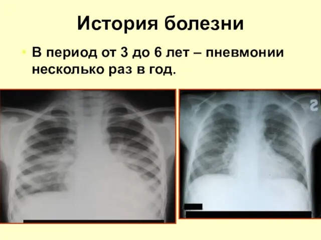 История болезни В период от 3 до 6 лет – пневмонии несколько раз в год.