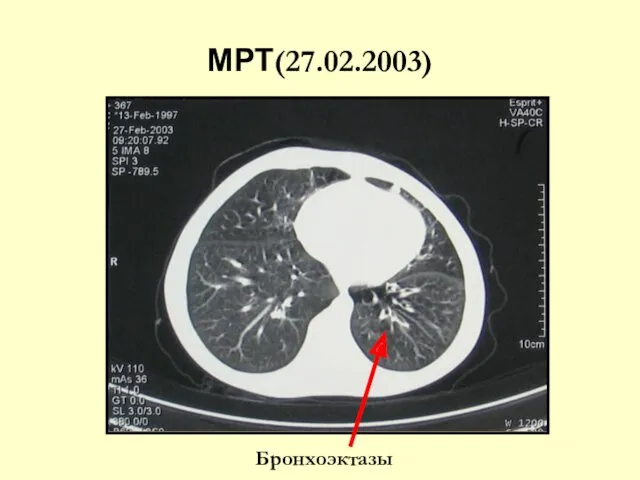 МРТ(27.02.2003) Бронхоэктазы