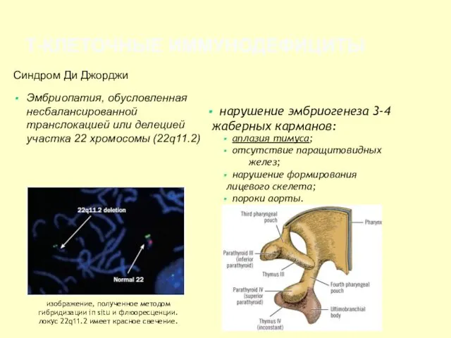 Т-КЛЕТОЧНЫЕ ИММУНОДЕФИЦИТЫ Синдром Ди Джорджи Эмбриопатия, обусловленная несбалансированной транслокацией или