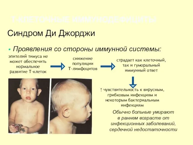 Синдром Ди Джорджи Проявления со стороны иммунной системы: Т-КЛЕТОЧНЫЕ ИММУНОДЕФИЦИТЫ