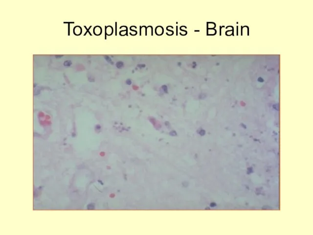 Toxoplasmosis - Brain