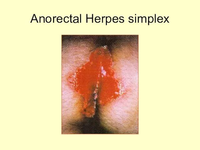 Anorectal Herpes simplex