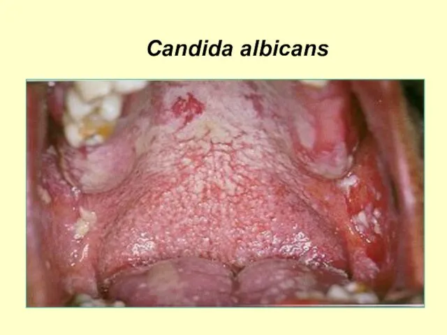 Candida albicans