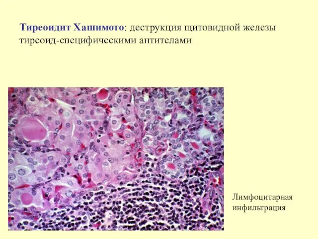 Тиреоидит Хашимото: деструкция щитовидной железы тиреоид-специфическими антителами Лимфоцитарная инфильтрация