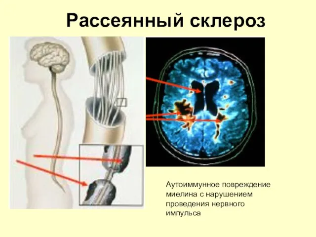 Рассеянный склероз Аутоиммунное повреждение миелина с нарушением проведения нервного импульса