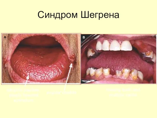 atrophic papillae, deeply fissured epithelium angular cheilitis missing teeth and multiple caries Синдром Шегрена