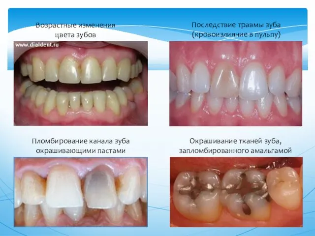 Возрастные изменения цвета зубов Последствие травмы зуба (кровоизлияние в пульпу)