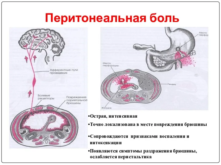 Перитонеальная боль Острая, интенсивная Точно локализована в месте повреждения брюшины