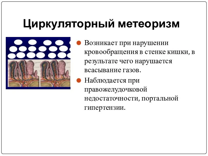 Циркуляторный метеоризм Возникает при нарушении кровообращения в стенке кишки, в