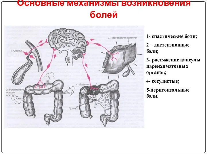 Основные механизмы возникновения болей 1- спастические боли; 2 – дистензионные