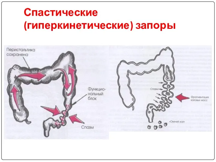 Спастические (гиперкинетические) запоры