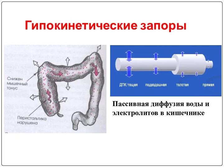 Гипокинетические запоры Пассивная диффузия воды и электролитов в кишечнике